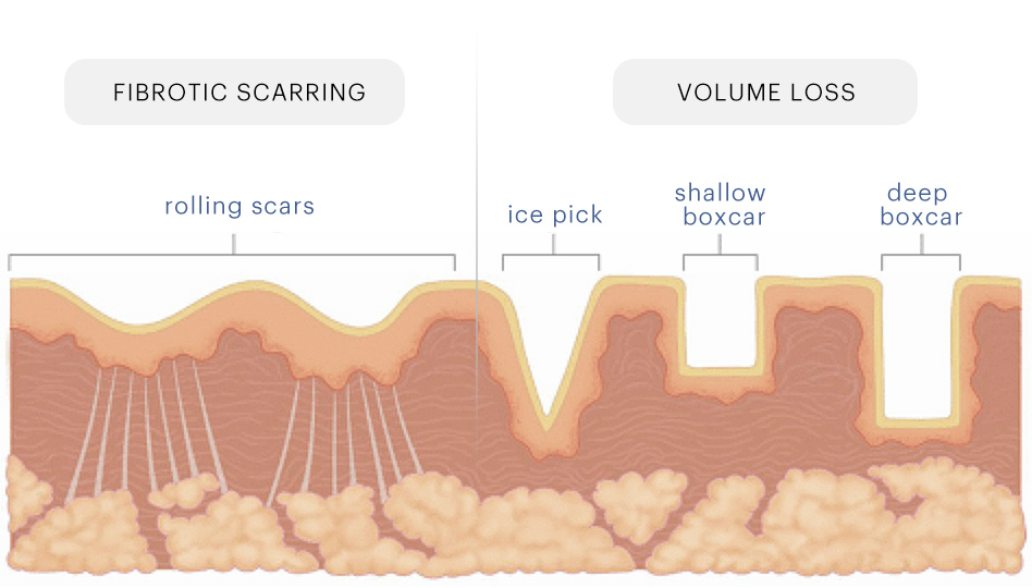 sylfirm-acne-scarring-type